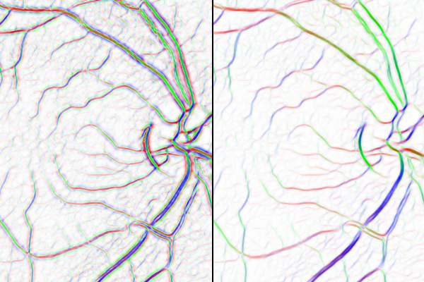 retinal fundus image processed using tensor voting